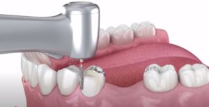 8 signs that you need dental implants