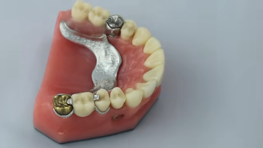 Are Dental Implants Considered Orthodontics