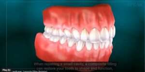 How Long Does Numbness Last After a Dental Filling