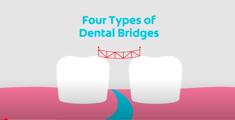 Symptoms of an Ill-Fitting Dental Bridge