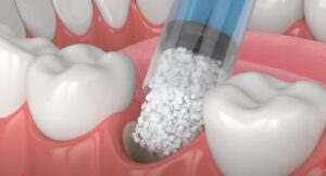 are you put to sleep for a dental bone graft​