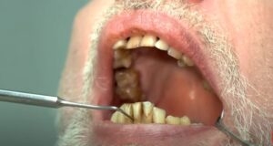 can a dental bridge be removed and recemented​