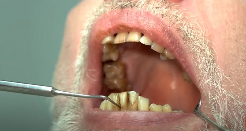 can a dental bridge be removed and recemented​