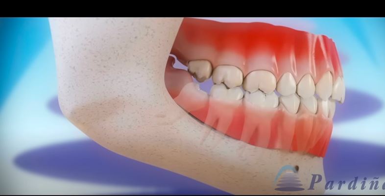 does removing wisdom teeth slim face