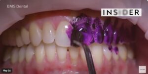 how long after a dental cleaning can i eat