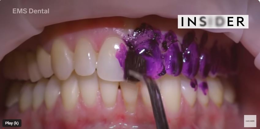 how long after a dental cleaning can i eat
