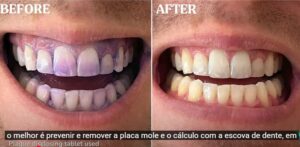 how to remove tartar from teeth without dentist