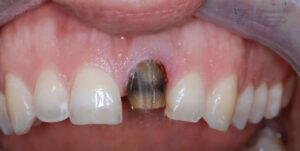 why teeth discolored after root canal